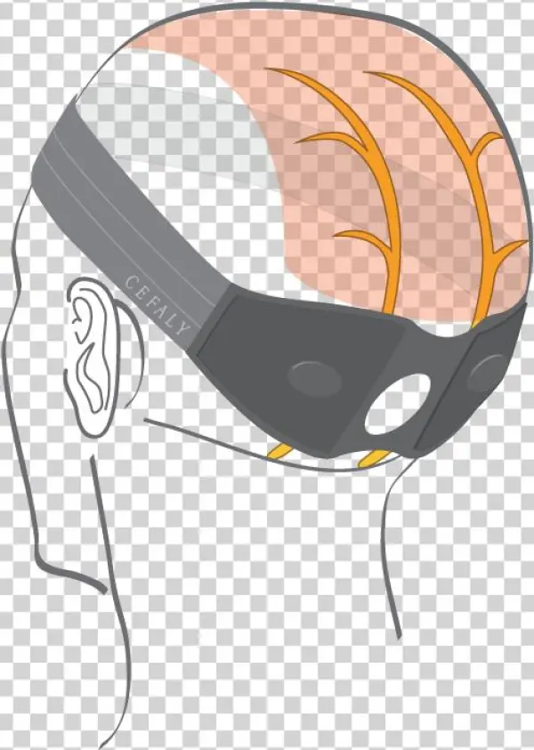Occipital Neuralgia