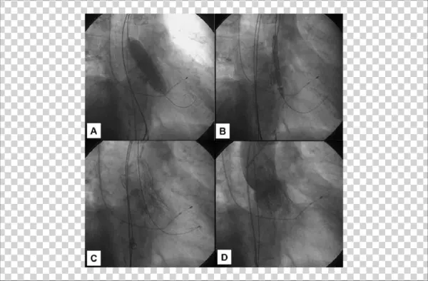 Alvoplastia Aórtica Por Balão , Para Pré-dilatação - Aortography