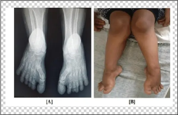A] Knock Knee/genu Valgum B] X Ray Foot Showing Short