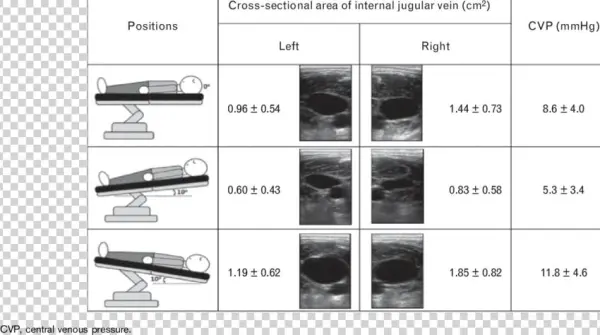 Cross-sectional Area Of Left And Right Internal Jugular