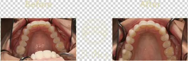 425 Before After Invisaline15
