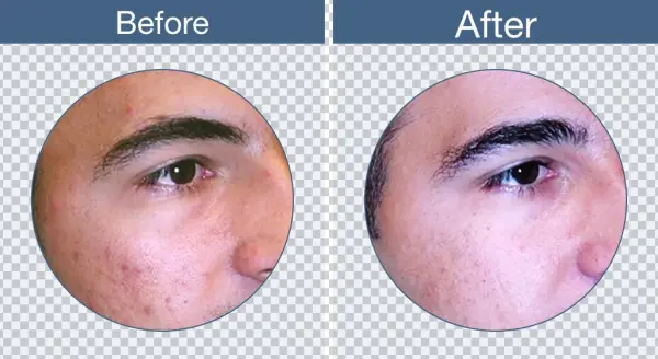 Clearogen Before & After