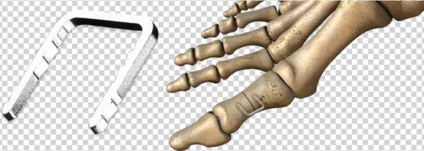 Charlotte™ Quick Staple - Bunion