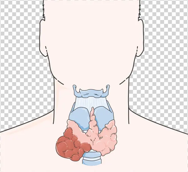 Cancer De La Thyroïde