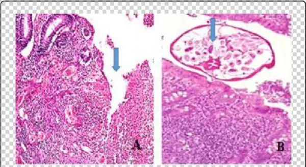 Entrobius Vermicularis In Appendix - Motif