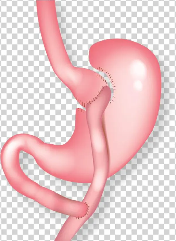 Illustration Of Gastric Bypass - Balloon