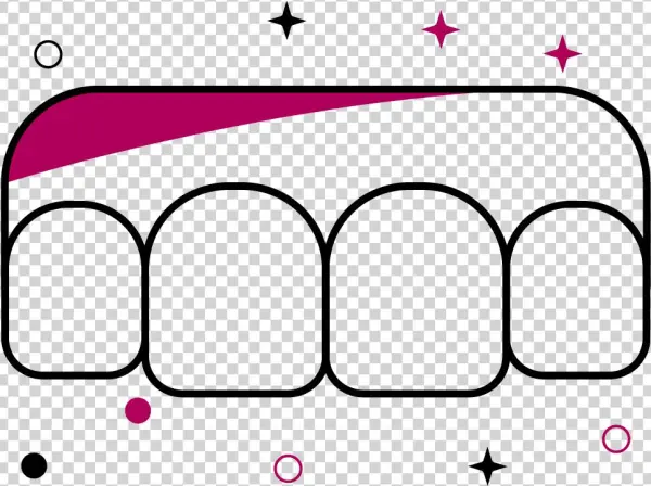 Aesthetic Gum Surgery - Diagram