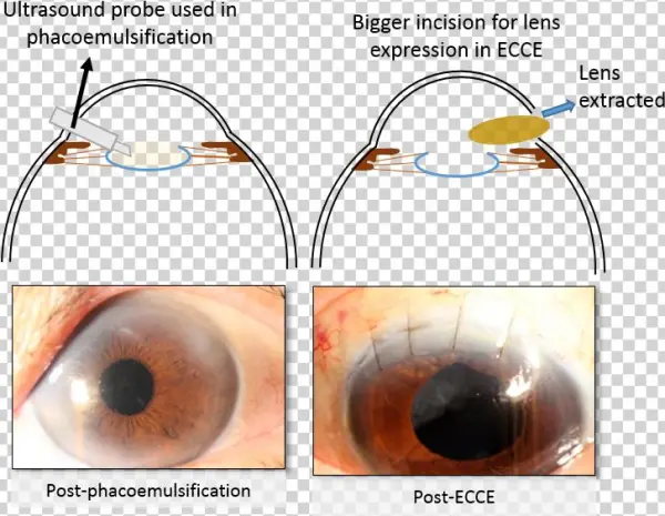Cataract Surgery - Circle