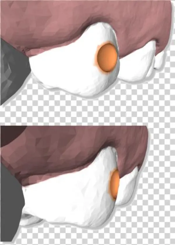 Maestro3d - Dental - Studio - Virtual - Setup - Negative - Dentistry