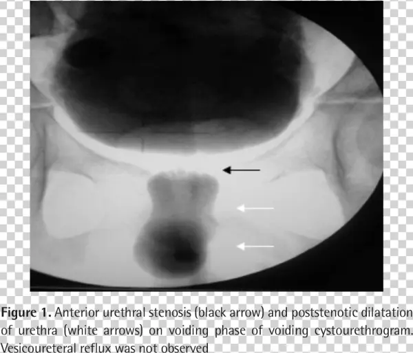 Cystourethroscopy Confirmed The Presence Of The Auv