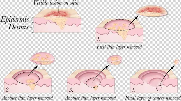 2010 Terese Winslow - Mohs Surgery