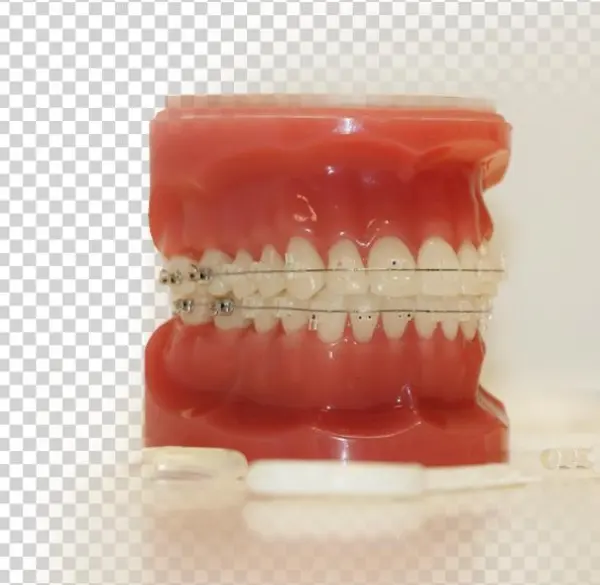 Clear Braces - Plastic