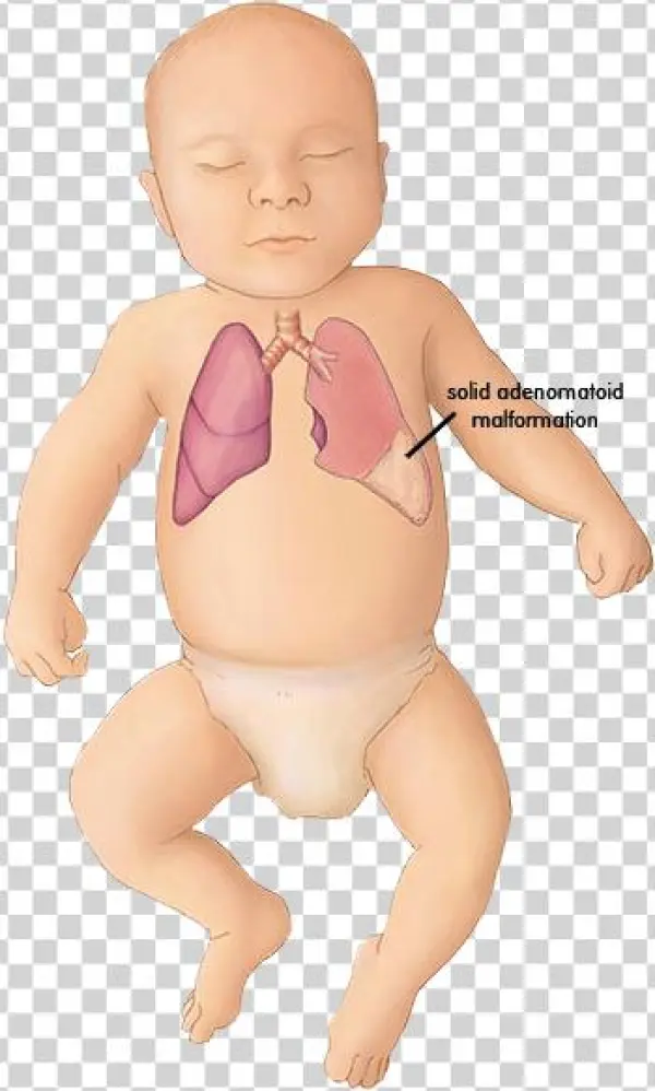 Enlarge Image » - Atresia Duodenal