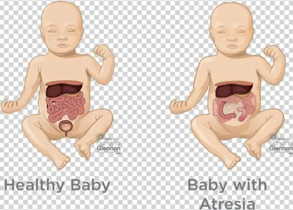 How Is It Managed And Treated During Pregnancy - Congenital Diaphragmatic Hernia