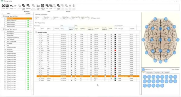 In-home Video Eeg And Ltm Monitoring - Natural Therapies For Parkinson's Disease By Laurie