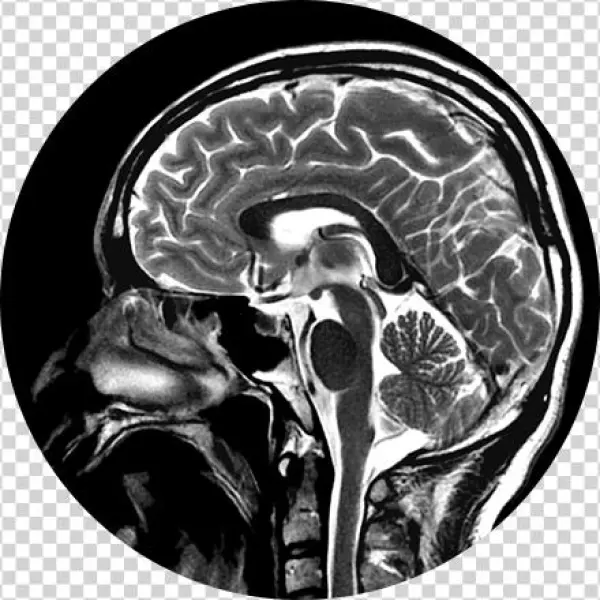 Brain, Head & Spine Imaging Image - Lmp Enfermedad