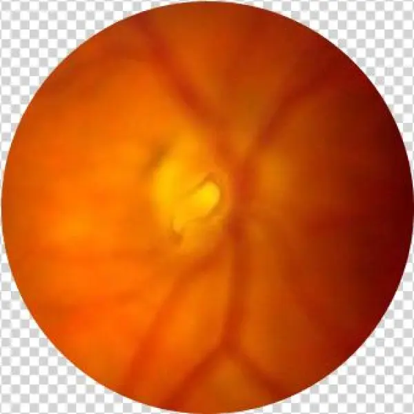 Flashes-floaters - Macular Degeneration