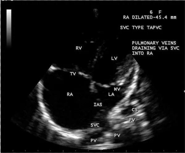 Svc Type Total Anamolous Pulmonary Venous Connection