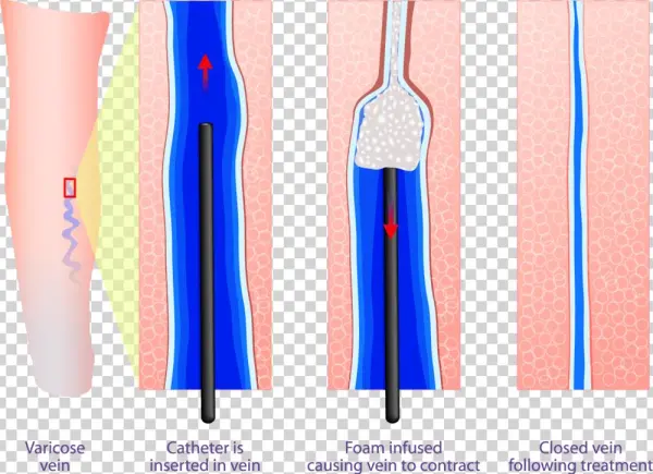 Sclerotherapy-treatment