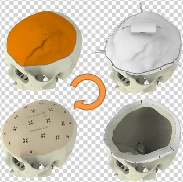 Meningioma 1 Stage - Cake