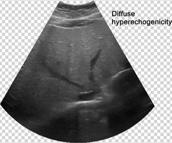 Fatty Liver - Miniskirt