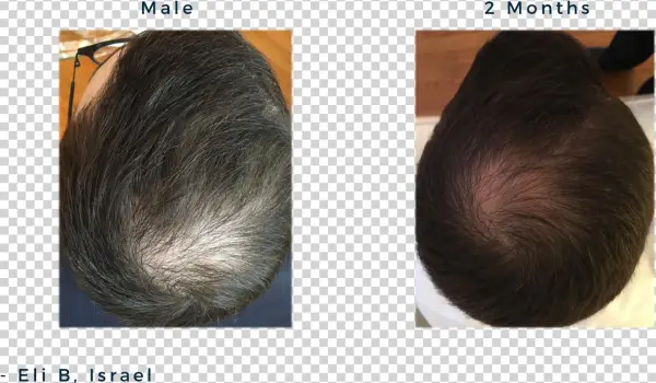 Male 20y, Androgenic Alopecia / Male Patterned Balding