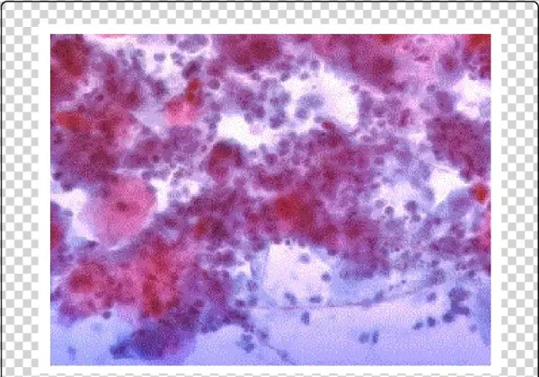 Yeast And Hyphae In Distal Esophagus Brush - Esophagus