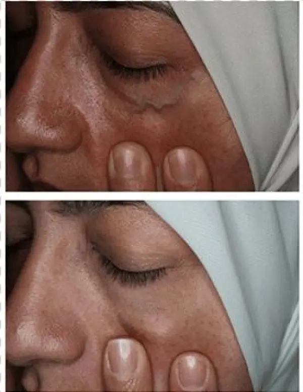 Facial Veins And Treatments - Sad