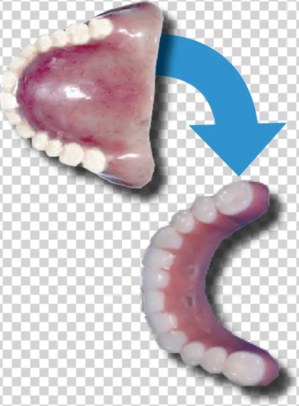 Implants There Is No Need For Thick, Long Flanges On - Insect