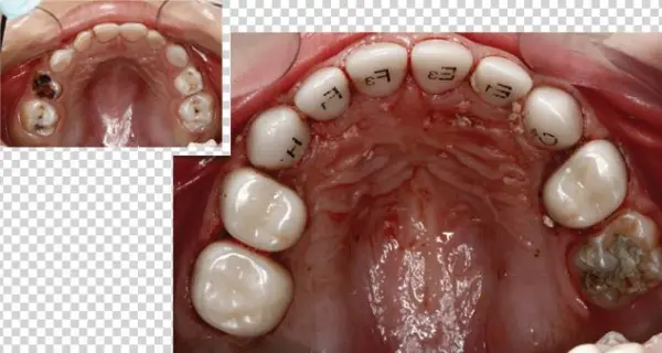 That Looks Natural, And Is Strong And Long Lasting - Ez Pedo Crown