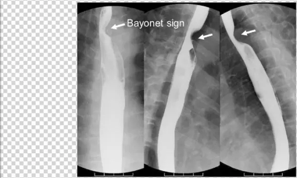 Upper Gastrointestinal Series Showed The Bayonet Sign,