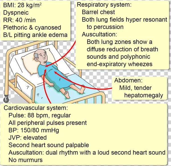 He Has Smoked For A Total Of 62 Pack Years, And Has