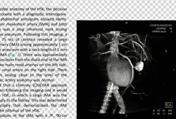 Horseshoe Kidney Classification System Based On The