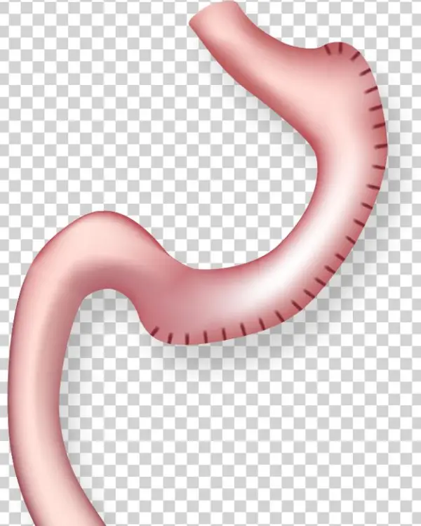 Illustration Of Stomach After Gastric Plication - Tüp Mide Ameliyatı