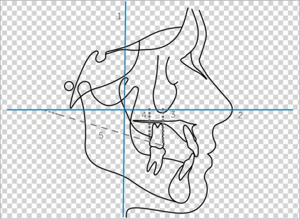 Lines Demarcated On The Lateral Teleradiograph - Line Art