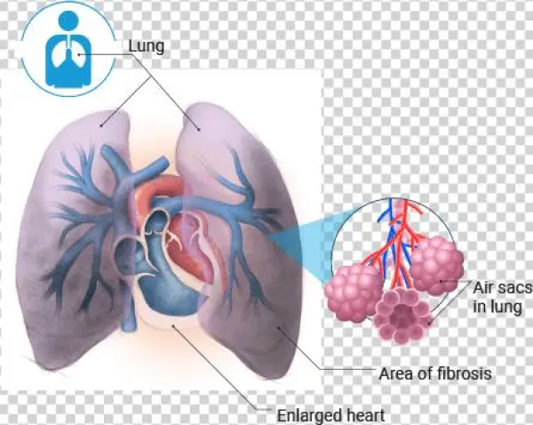 Idiopathic Pulmonary Fibrosis - Respiratory Care: Assessment And Management [book]