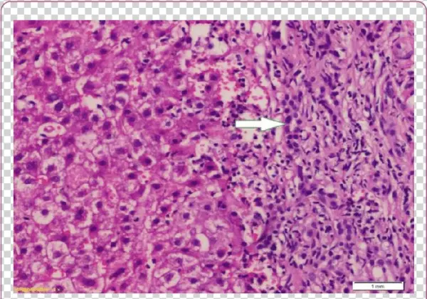 High Power View Of The Previous Slide Showed Numerous - Fibrosis