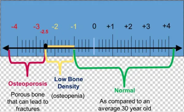 Understanding Bone Density Results
